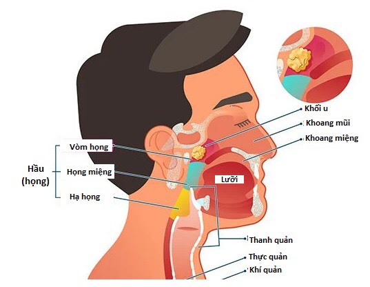 Phân biệt ung thư vòm họng giai đoạn đầu và bệnh lý mũi họng