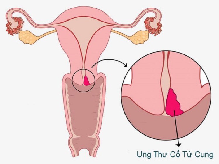 ung thư cổ tử cung là gì? Làm sao phát hiện được bệnh?