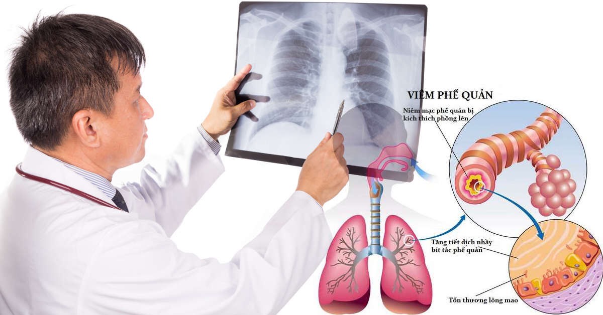 Viêm phế quản phổi gần bạn như thế nào khi không khí ô nhiễm?
