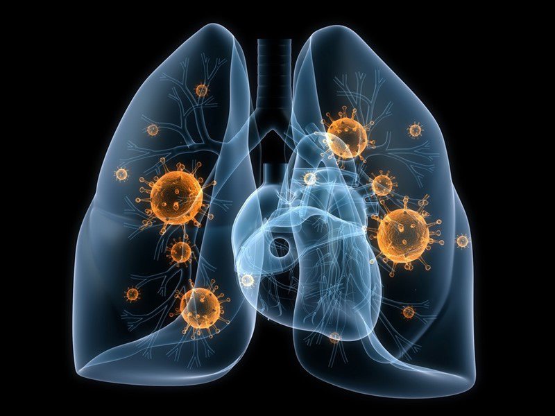 ung thư phổi di căn - những điều cần biết