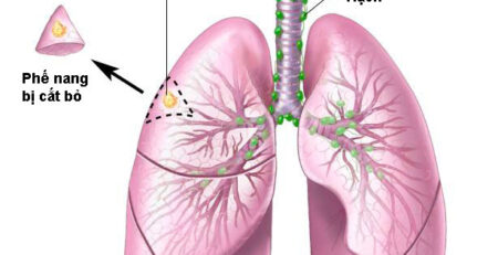 Câu trả lời cho ung thư phổi có chữa được không?