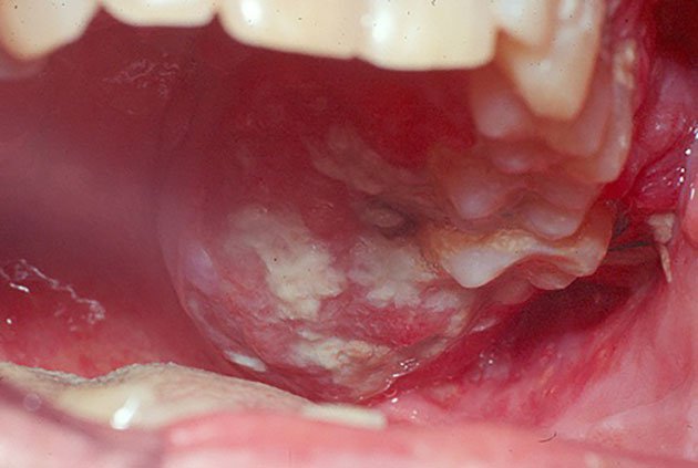 Triệu chứng cảnh báo ung thư khoang miệng không thể bỏ qua