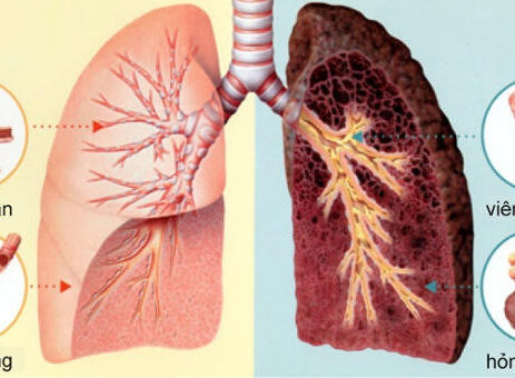 ung thư phổi sống được bao lâu? Làm gì để tăng tuổi thọ