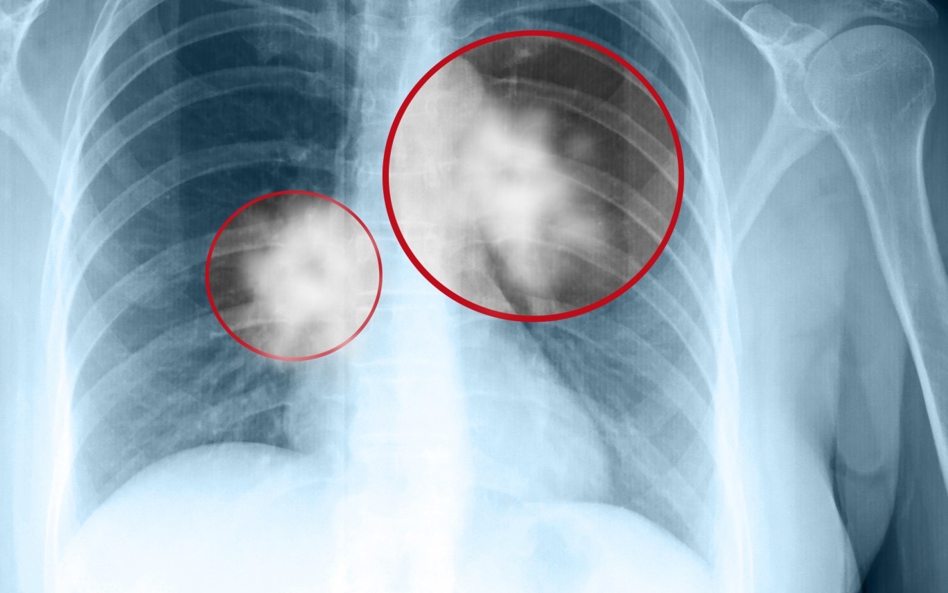 Hình ảnh x quang ung thư phổi 