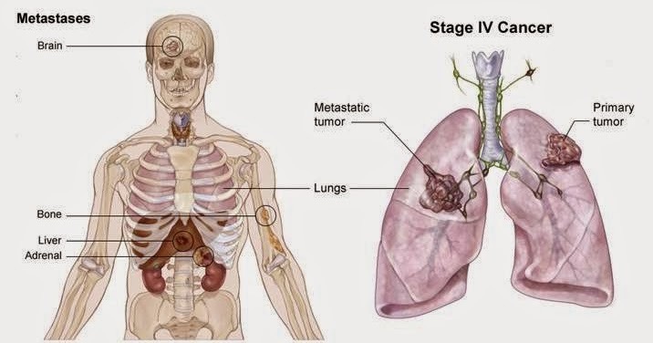 làm sao để mạnh mẽ vượt qua ung thư phổi đã di căn?