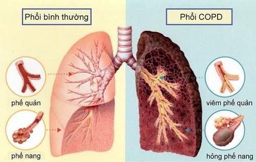 Nguyên nhân chính gây bệnh phổi tắc nghẽn mãn tính copd là gì?