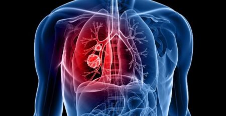 làm sao để mạnh mẽ vượt qua ung thư phổi đã di căn?