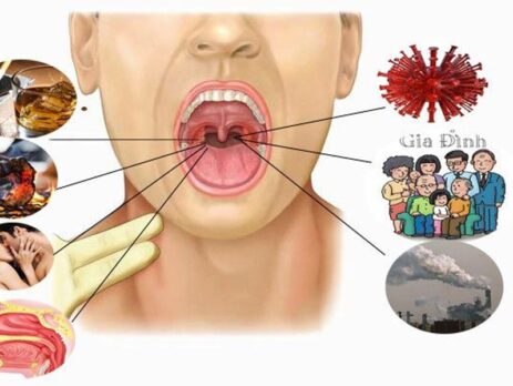 Ung thư vòm họng có chữa được không?