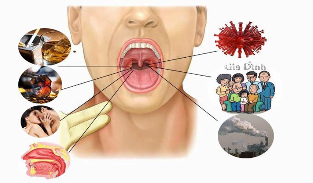 Ung thư vòm họng có chữa được không?