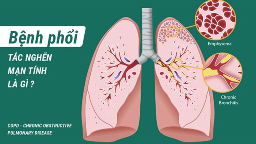 Bạn đã biết cách phòng tránh bệnh phổi tắc nghẽn mạn tính?