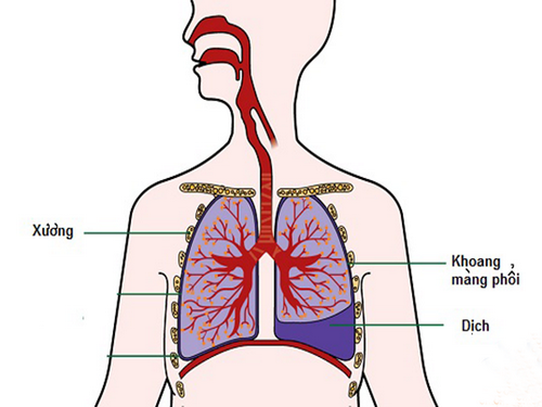 Bệnh lao phổi là một căn bệnh truyền nhiễmnguy hiểm