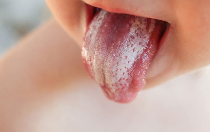 Thông tin quan trọng về bệnh nấm lưỡi