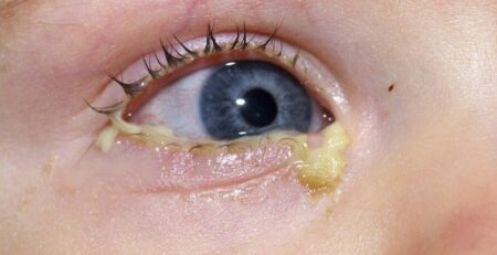 Triệu chứng và phương pháp điều trị mắt đỏ