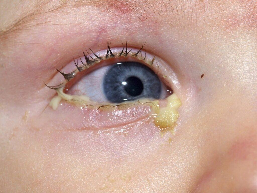 Bị đau mắt đỏ kiêng ăn gì?