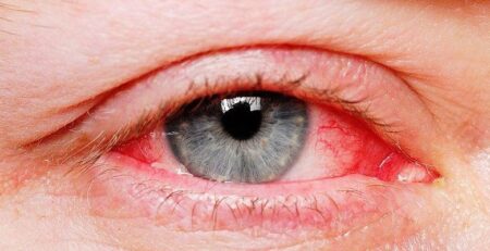 Những điều cần biết về đau mắt đỏ