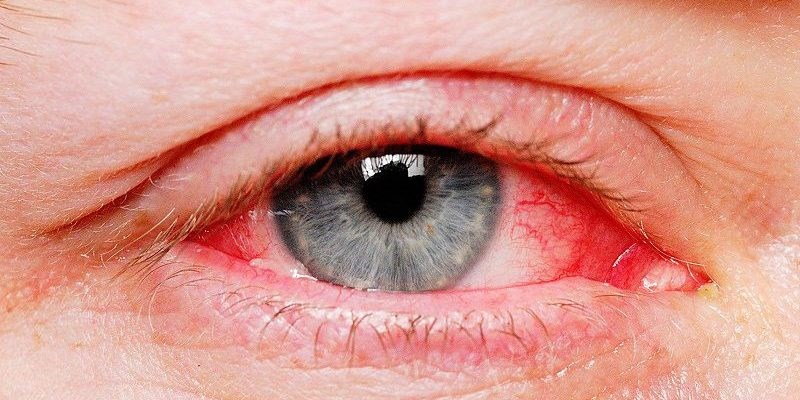Triệu chứng và phương pháp điều trị mắt đỏ