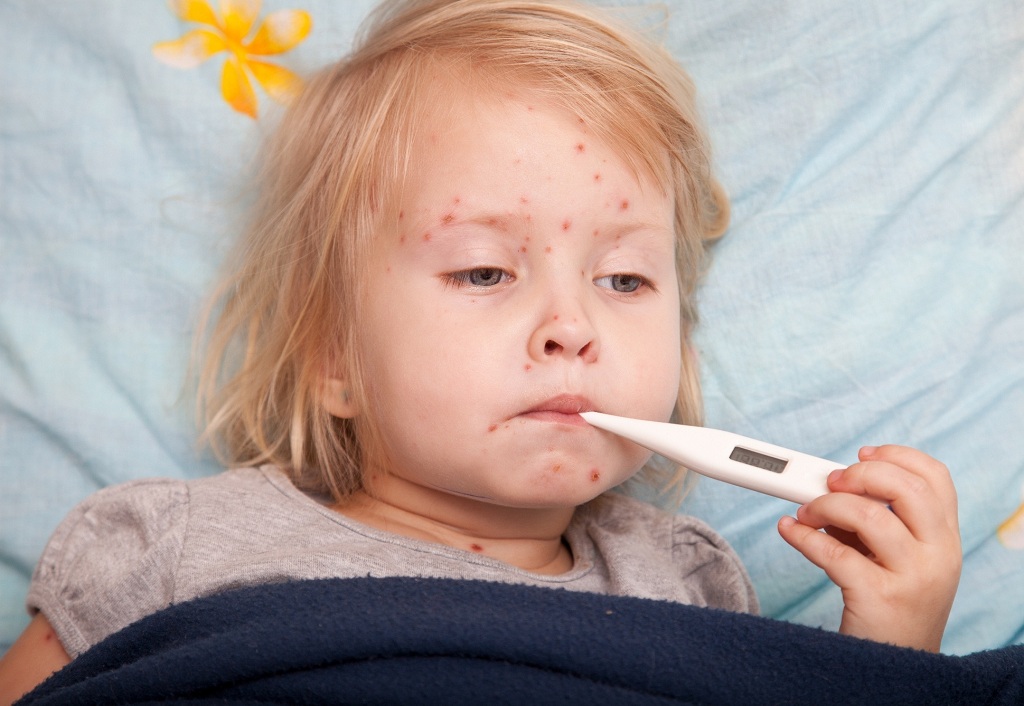 Phân biệt bệnh sởi là gì và sốt phát ban