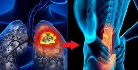 Làm sao đối mặt với ung thư phổi di căn xương?