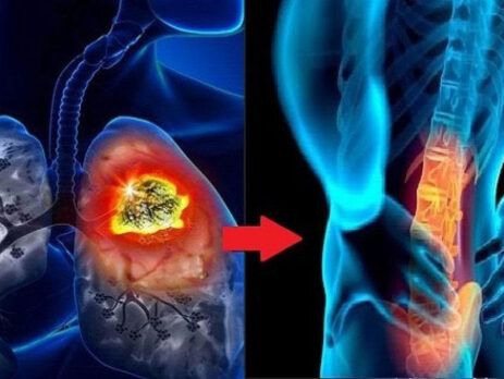 Làm sao đối mặt với ung thư phổi di căn xương?