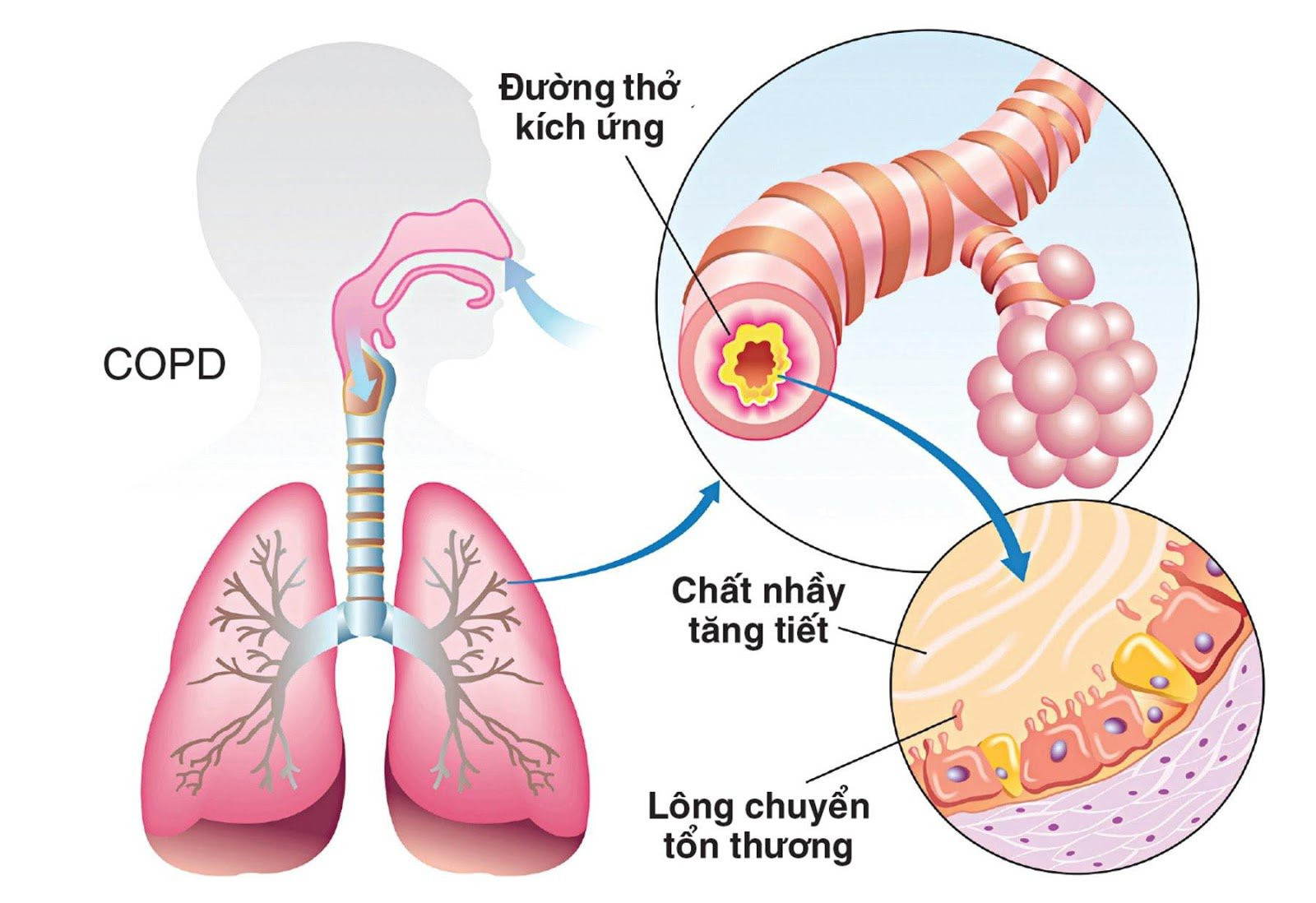 Nguyên nhân chính gây bệnh phổi tắc nghẽn mãn tính copd là gì?