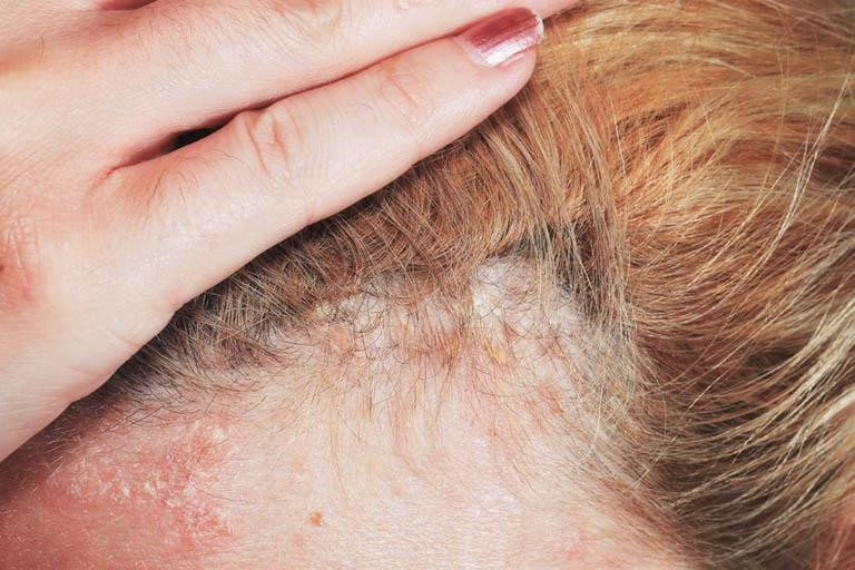 Vảy nến da đầu có nguy hiểm không?