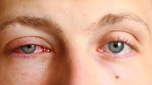 Bị đau mắt đỏ nên làm gì