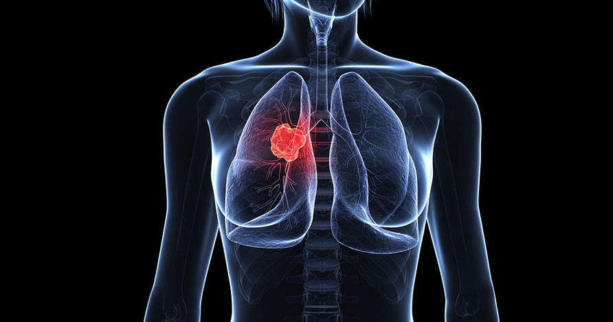 ung thư phổi có lây không? ung thư phổi có di truyền không?