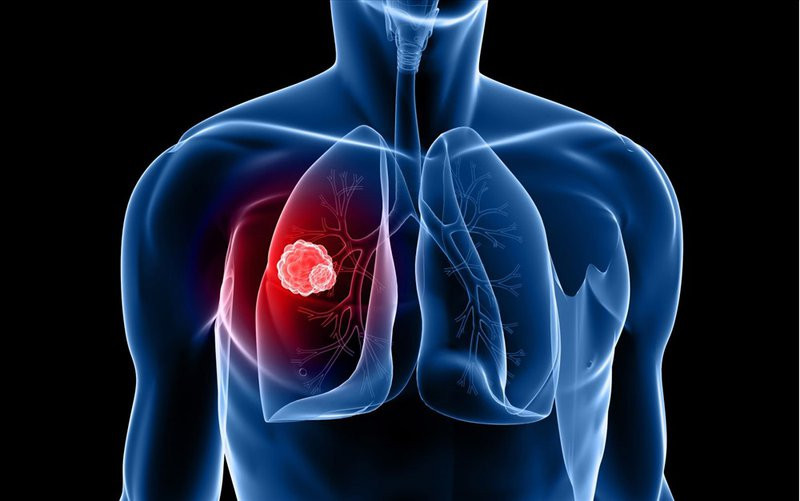 ung thư phổi giai đoạn đầu nguy hiểm không