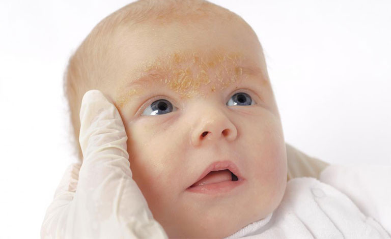 Chăm sóc da bị khô trẻ sơ sinh đặc biệt khác người lớn