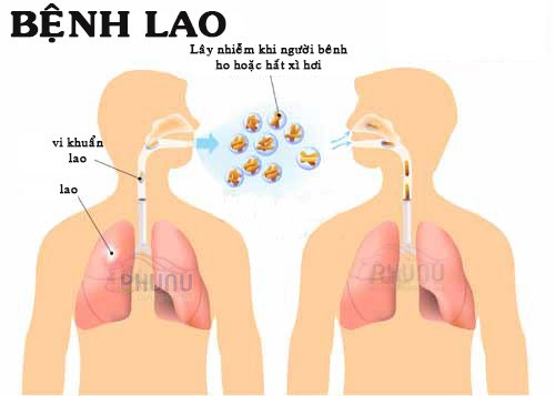  Bệnh lao phổi có thể chữa trị được nếu điều trị kịp thời
