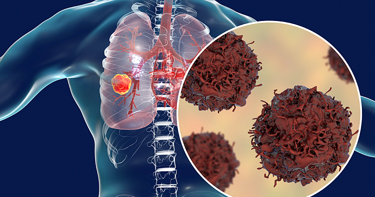 Bệnh ung thư phổi giai đoạn cuối khiến cơ thể chứa nhiều u ác tính và đã di căn 
