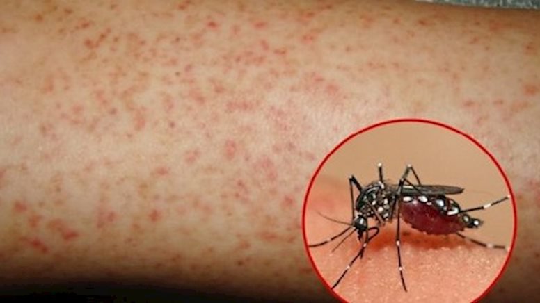 Sốt xuất huyết là gì? Các bệnh về sốt xuất huyết