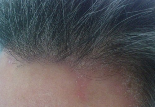 Bệnh nấm da đầu có nguy hiểm không