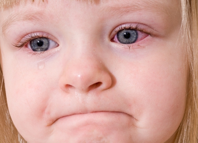 Những điều cần biết về đau mắt đỏ ở trẻ em