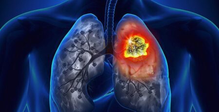 Lao phổi là gì? Biện pháp phòng tránh bệnh lao phổi