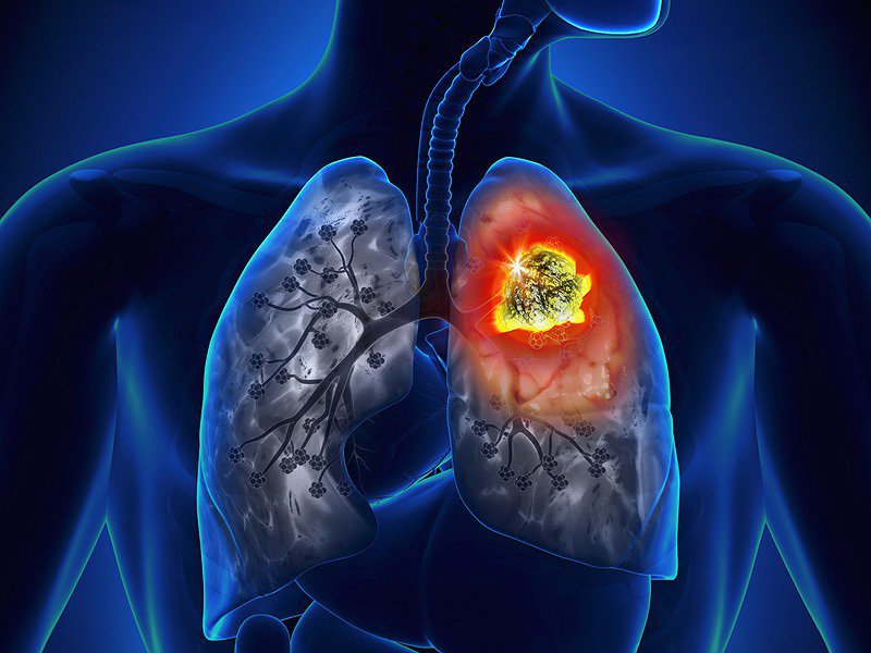 Bệnh lao phổi là một căn bệnh truyền nhiễm nguy hiểm