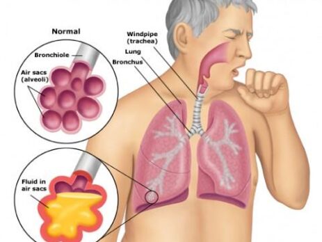 ung thư phổi giai đoạn đầu