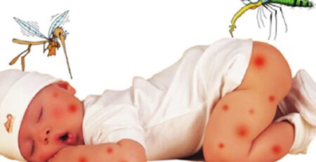 Chăm sóc vết thương bị muỗi đốt trên da cho bé đúng cách