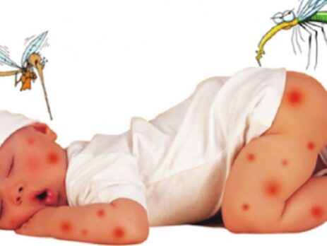 Chăm sóc vết thương bị muỗi đốt trên da cho bé đúng cách
