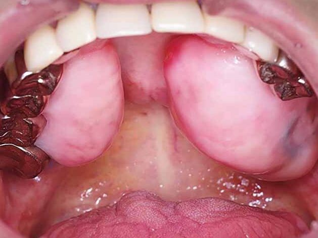 Triệu chứng cảnh báo ung thư khoang miệng không thể bỏ qua