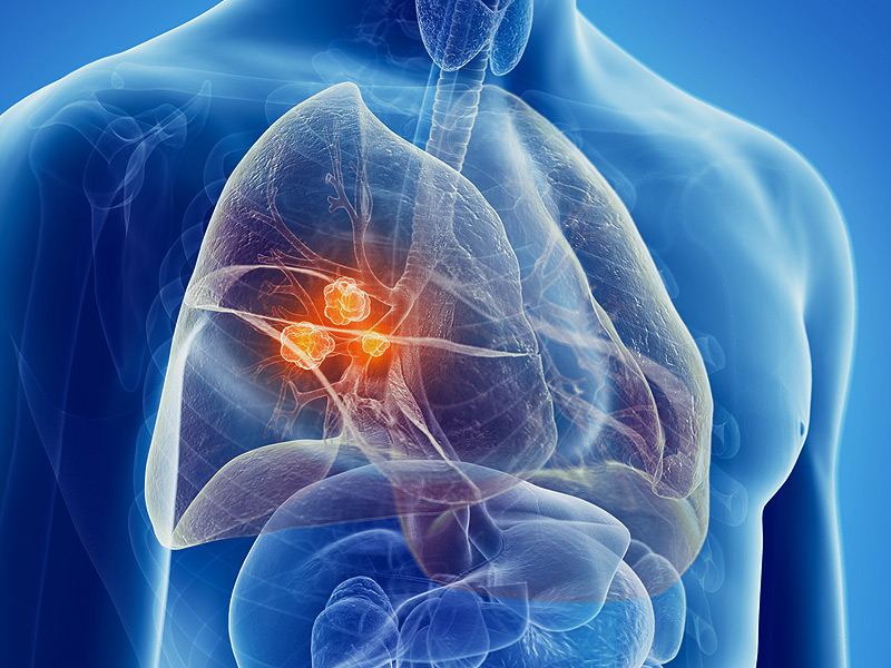 Ung thư phổi giai đoạn 4 là căn bệnh phổ biến hiện nay