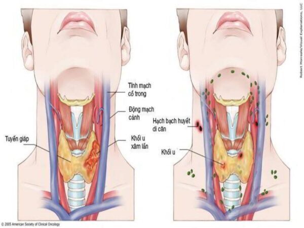 Chẩn đoán ung thư vòm họng qua các triệu chứng