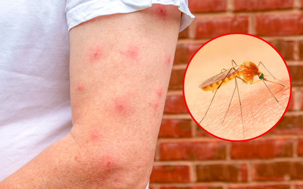 muỗi cắn gây sưng và đỏ da