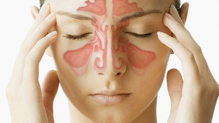 Phân biệt viêm xoang mũi dị ứng và viêm mũi thông thường
